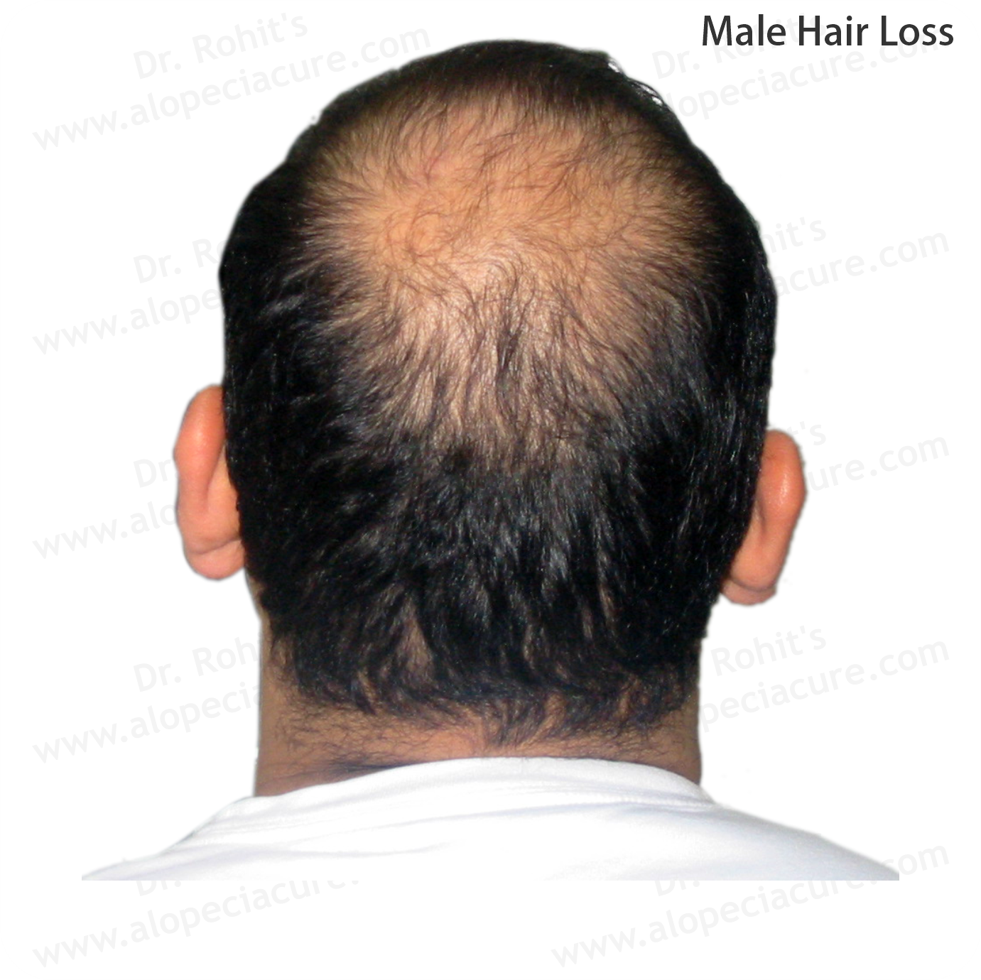 Male Hair Loss Clinical Treatment